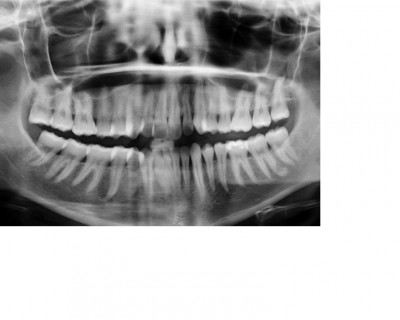 ortopanoramica tully frontale.jpg
