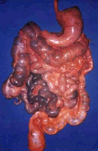 Colon Malato Colon malato