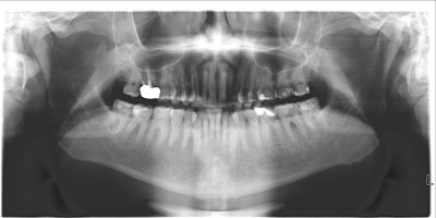 PANORAMICA DENTALE