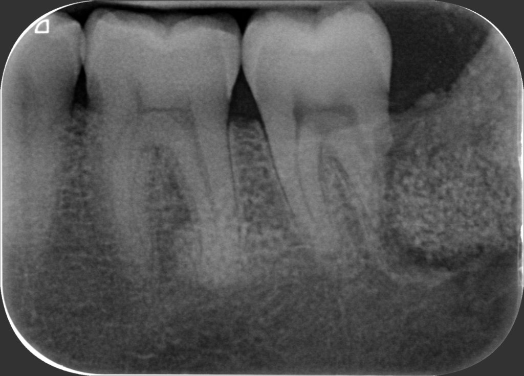 38 – Radiografia 27 Luglio 2021 (operato il 30 Giugno)