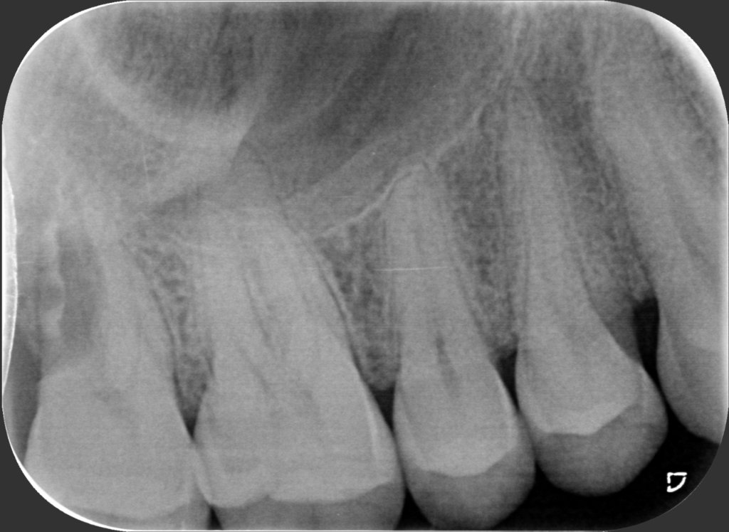 18 – Radiografia  15 Dicembre 2021 (operato il 1 Settembre)