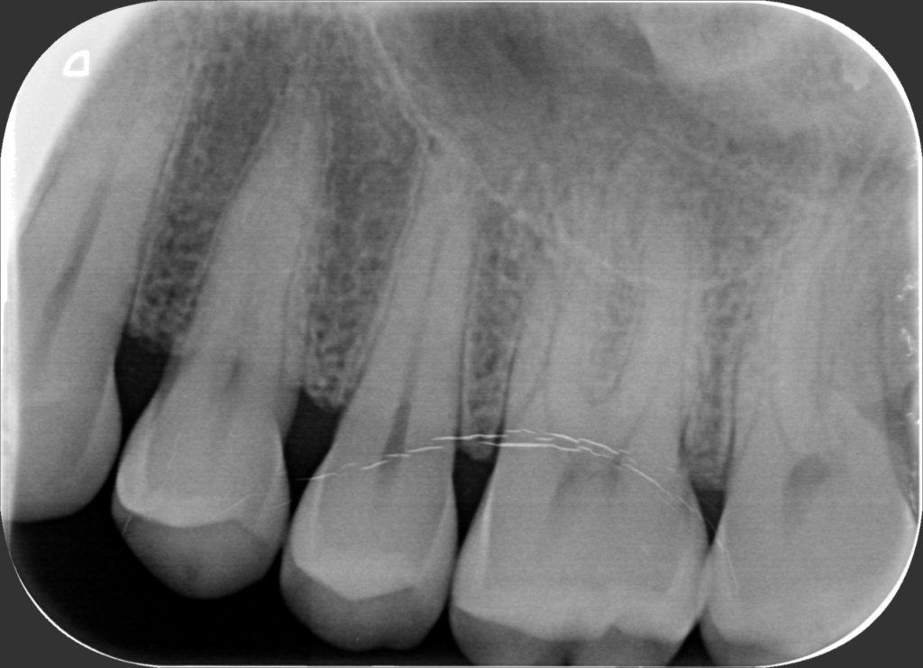 28 – Radiografia  15 Dicembre 2021 (operato il 1 Settembre)