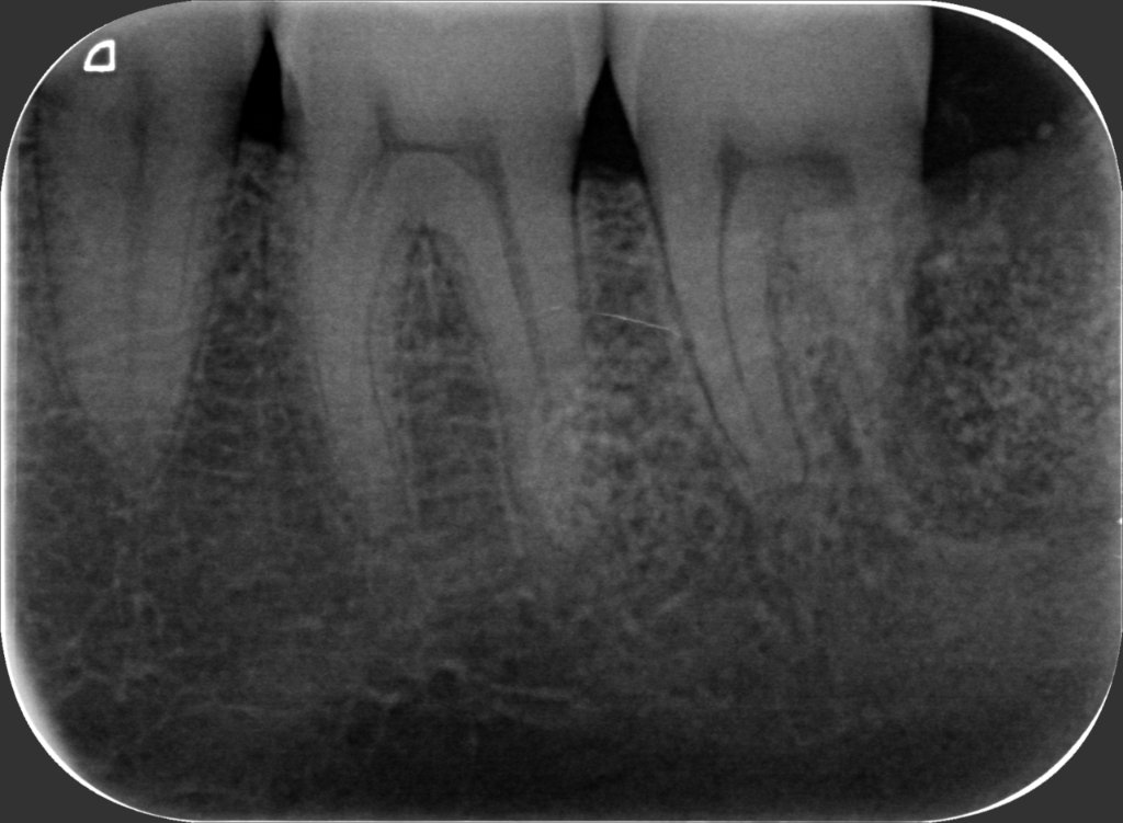 38 – Radiografia  15 Dicembre 2021 (operato il 30 Giugno)