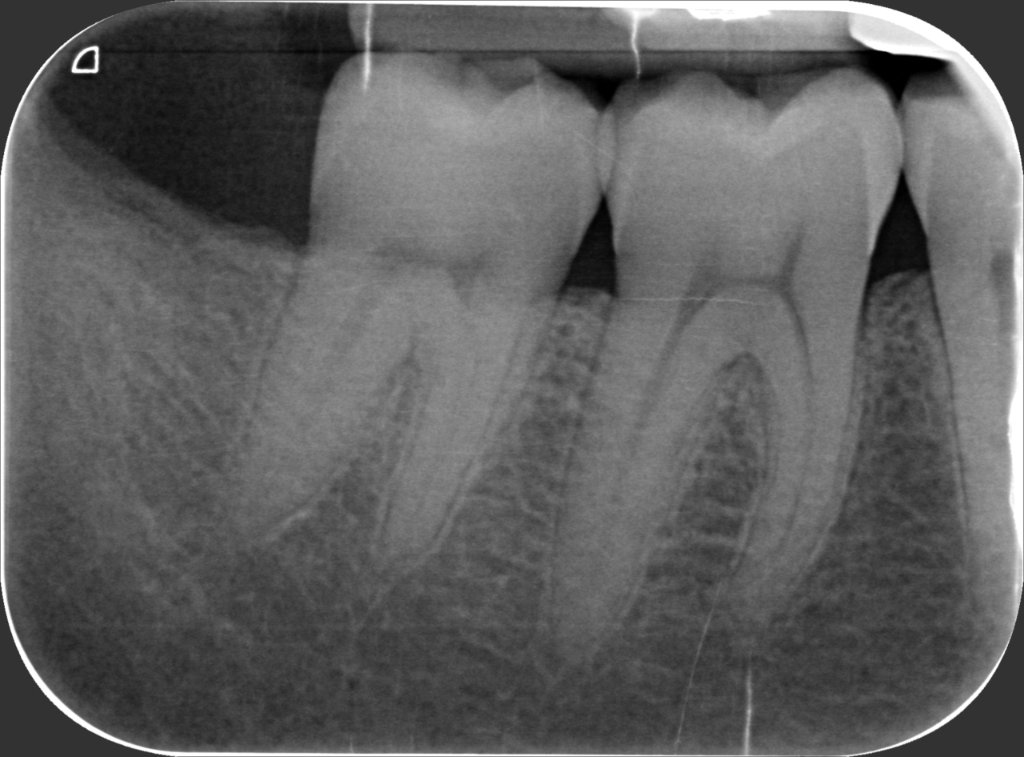 48 – Radiografia  15 Dicembre 2021 (operato il 17 Maggio)