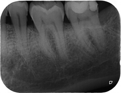 Sx inferiore con radice.jpg