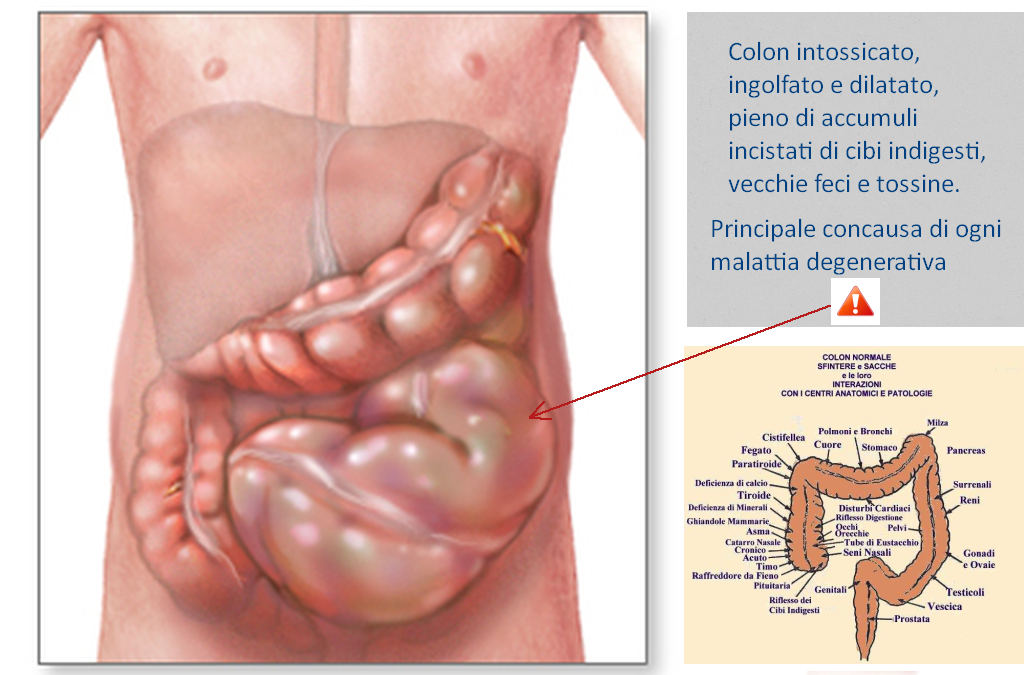 colon intossicato fonte di malattia