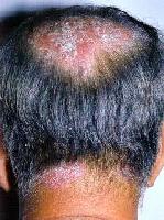 Psoriasi 1