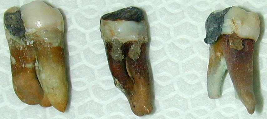 denti devitalizzati denti devitalizzati