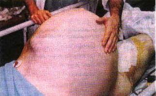 addome dilatato