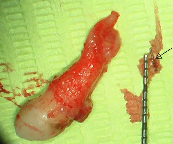 Dente e frammento fresa