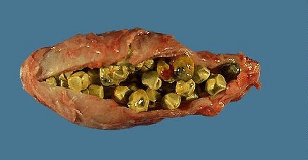 lavaggio epatico